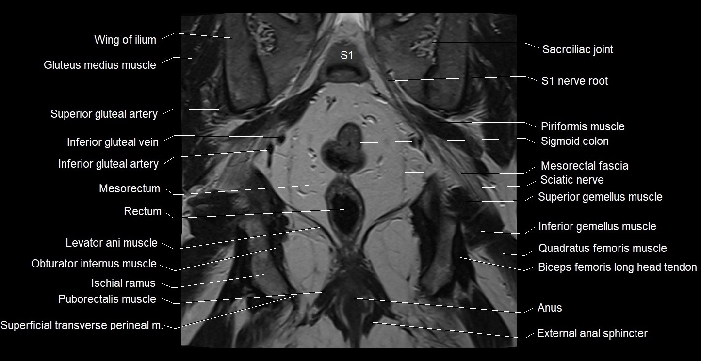 MRI coronal cross sectional anatomy male pelvis image 29.webp
